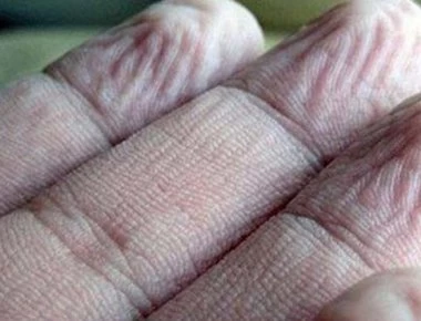 Που οφείλονται τα ζαρωμένα δάχτυλα μετά το μπάνιο;